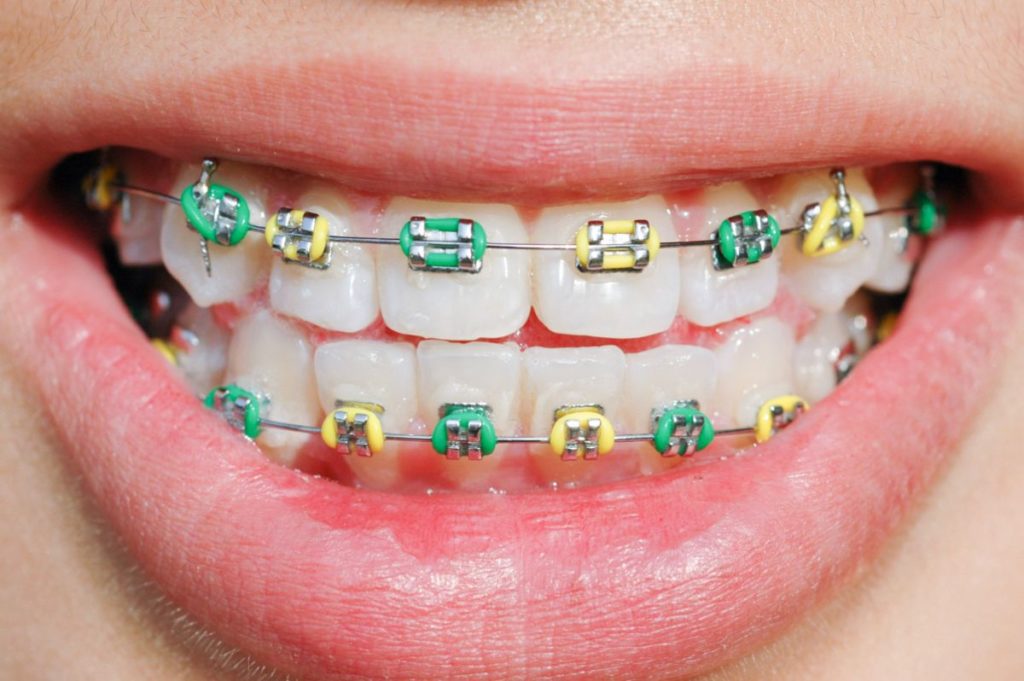 10 Braces Myths You Need To Know Dr Jared Lee Orthodontics 1974